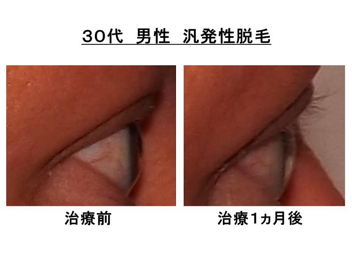 円形脱毛症　病院""